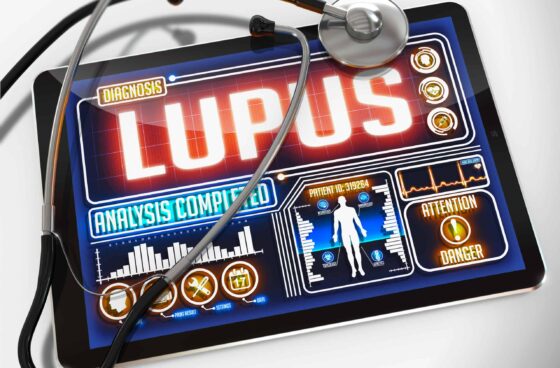 Environmental Exposures & Lupus